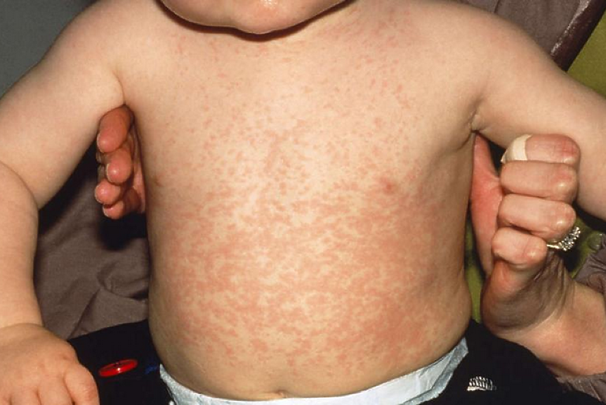 Лъжа или истина: заразяването с дребна шарка полезно ли е за имунитета и пази ли от рак?