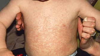 Лъжа или истина: заразяването с дребна шарка полезно ли е за имунитета и пази ли от рак?