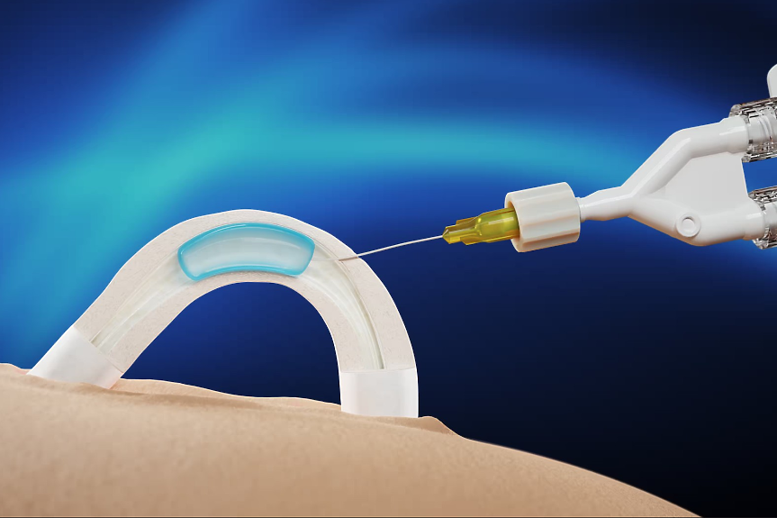Имплант обещава нова епоха в мъжката контрацепция: ефективност поне две години без хормони