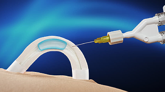 Имплант обещава нова епоха в мъжката контрацепция: ефективност поне две години без хормони